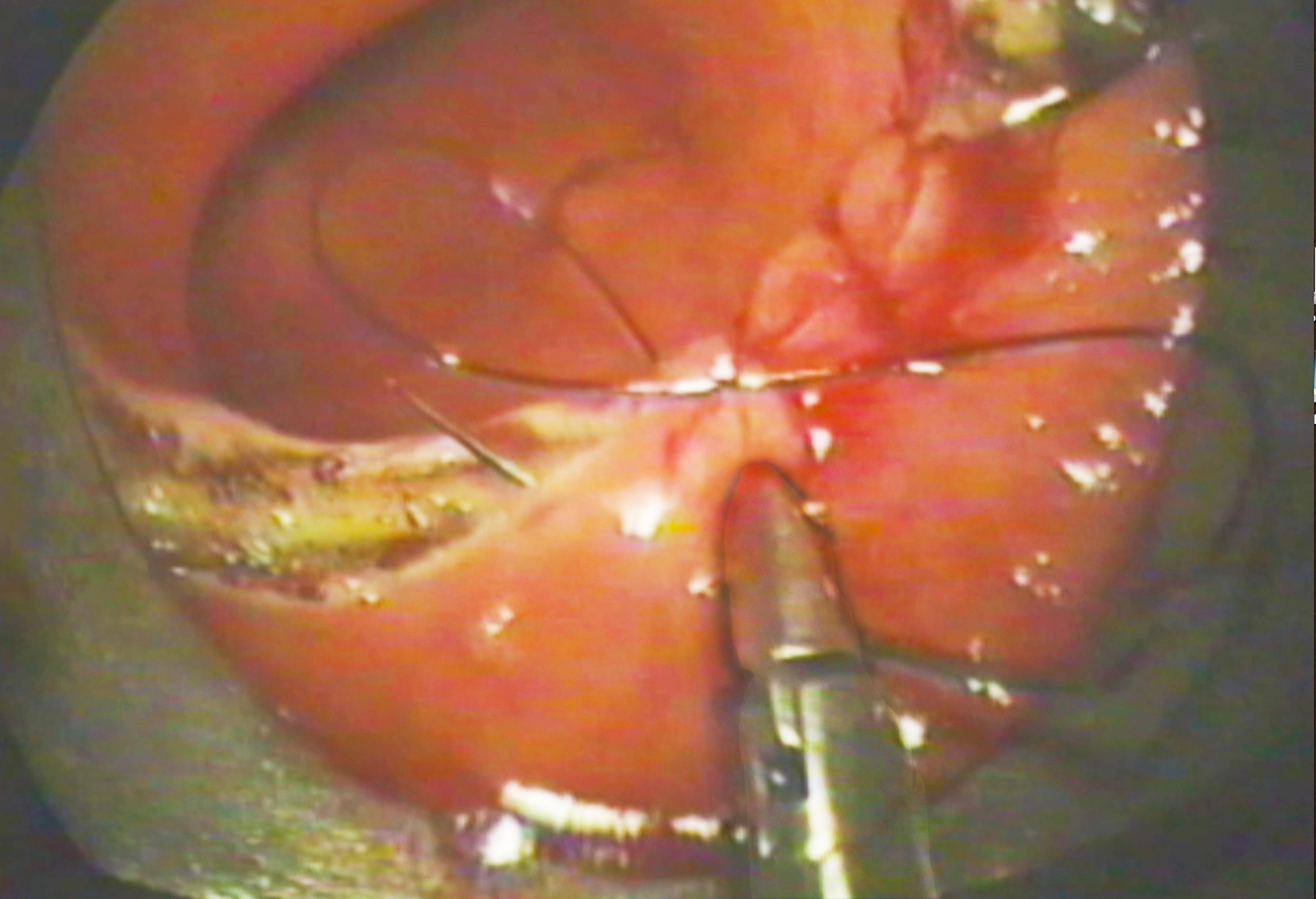 Transanal endoscopic surgery demonstrating suturing technique.